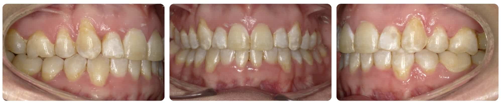 Final Orthodontic Treatment Cedar Smiles Orthodontics in Marysville, OH