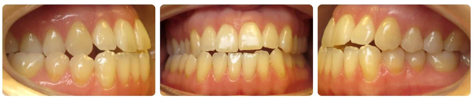 Before Orthodontic Treatment Cedar Smiles Orthodontics in Marysville, OH