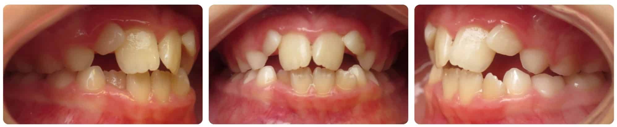 Before Orthodontic Treatment Cedar Smiles Orthodontics in Marysville, OH